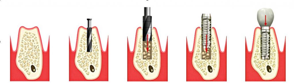 implanty zębów Kraków